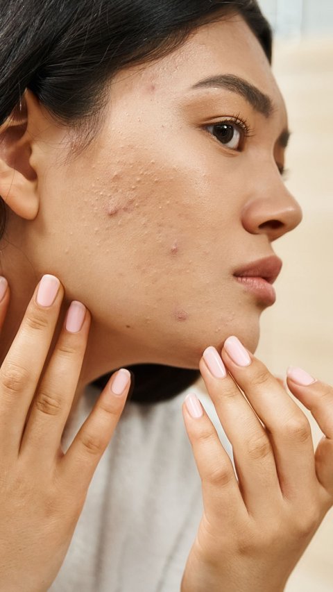 Not Effective to Use Skincare, 3 Important Procedures to Treat Acne Scars Recommended by Dermatologists