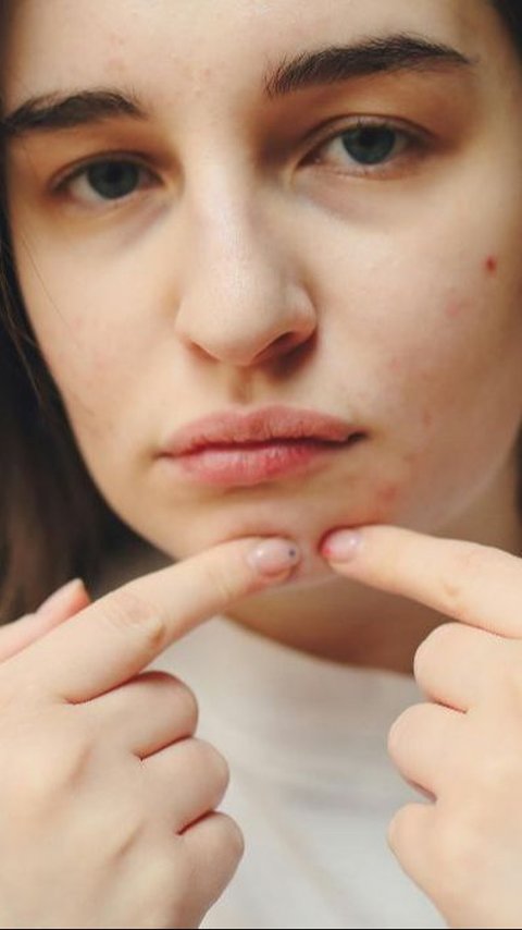 7 Types Of Acne That Affect Health and How To Treat Them
