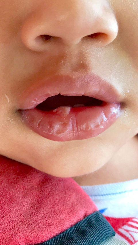 Understanding Lip Blisters in Babies That Often Occur During the Early Stages of Breastfeeding