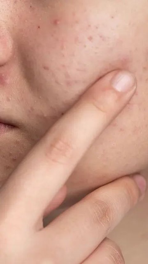 9 Cara Mengatasi Wajah Alergi Skincare Hanya dengan Bahan Alami