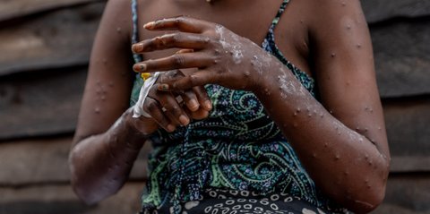 Kontak Seksual Bisa Tularkan Cacar Monyet