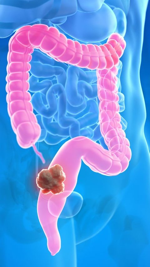Kanker Usus Mengintai Usia Muda, Kenali Penyebab dan Cara Mengatasinya