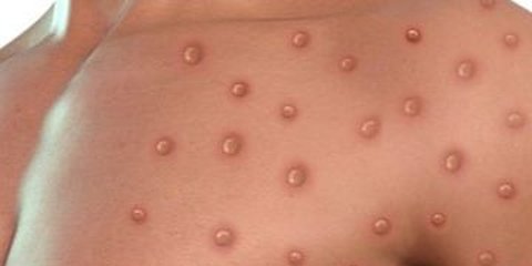 Satu Warga Suspek Monkeypox, Dinkes Sumsel Pastikan Hanya Cacar Biasa