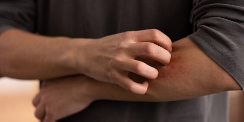Cara Mengatasi Alergi Seafood, Ini yang Terjadi Jika Tubuh Tidak Bisa Menerima Makanan Laut