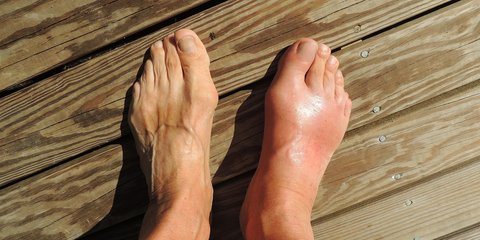 Waspadai! Ini 7 Gejala Asam Urat yang Sering Muncul di Kaki