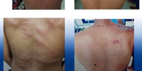 Tragis, Tubuh Mahasiswa Poltek Perikanan di Kupang Penuh Memar Usai Dipukuli Senior Pakai Pipa dan Selang Shower