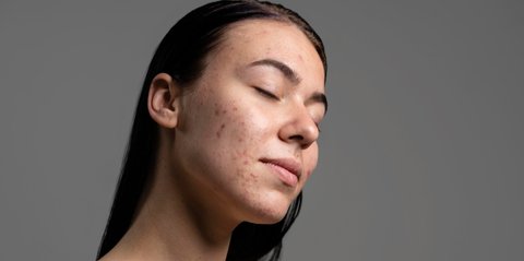 Bukan Pakai Banyak Skincare, Ini Cara Cepat Mengatasi Jerawat Tanpa Iritasi dan Minimal Bahan Aktif