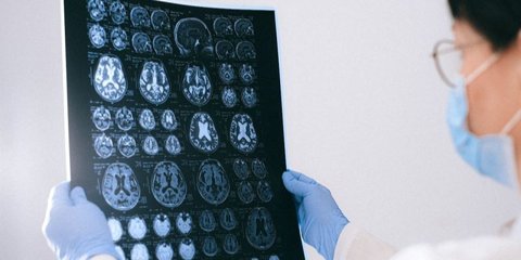 Bahaya Serangan Pasca-Stroke, Komplikasi Mematikan yang Perlu Diwaspadai