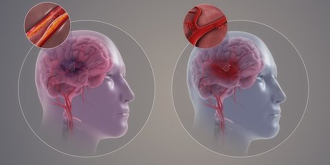 Jangan Panik Saat Stroke Terjadi: Langkah-Langkah Pertolongan Pertama yang Wajib Diketahui