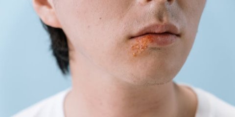 Cacar Api atau Herpes Zoster Bisa Dicegah Melalui Vaksin, Kenali Faktanya!