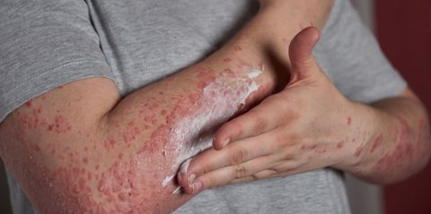 Mengenal Steven Johnson Syndrome: Gejala Awal, Penyebab, Komplikasi, dan Perawatan