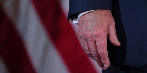 Tangan Kanan Trump Memar dan Kakinya Bengkak, Penyebabnya Ternyata Terlalu Banyak Jabat Tangan