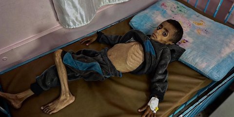 Tak Ada Air Bersih dan Susu, Anak-Anak Gaza Kena Wabah Meningitis
