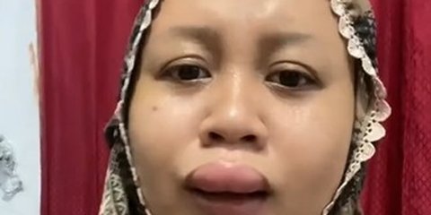 Nasib Apes Jelang Pernikahan, Bibir Wanita Ini Tiba-tiba Jeding