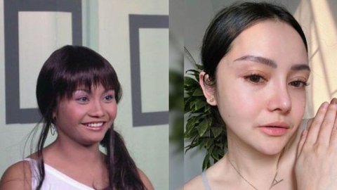 16 Transformasi Artis Sebelum dan Sesudah Operasi Hidung, Ada yang Sampai Beberapa Kali Oplas