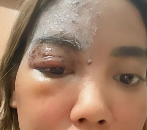 Posting Vacation Photos Ends in Disaster, Woman Gets Affected by Evil Eye After Being Complimented for Her Beauty, Her Eyes Immediately Swell