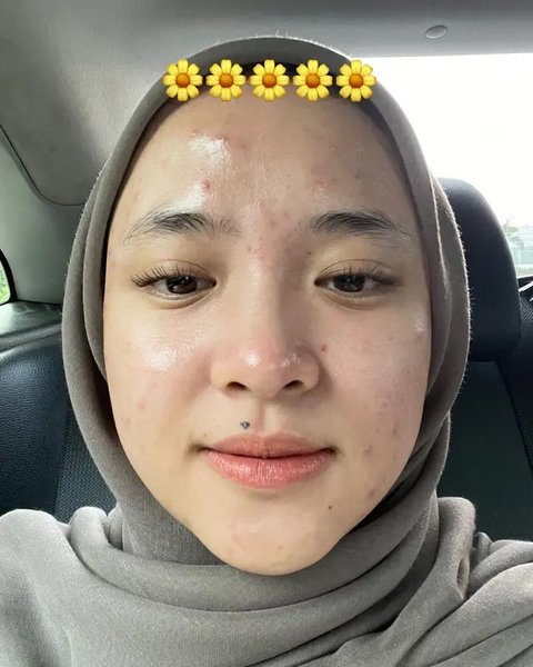 Potret Nissa Sabyan Percaya Diri Tampilkan Wajah Berjerawat Tanpa Makeup, Bikin Pangling