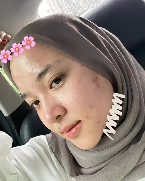 Potret Nissa Sabyan Percaya Diri Tampilkan Wajah Berjerawat Tanpa Makeup, Bikin Pangling