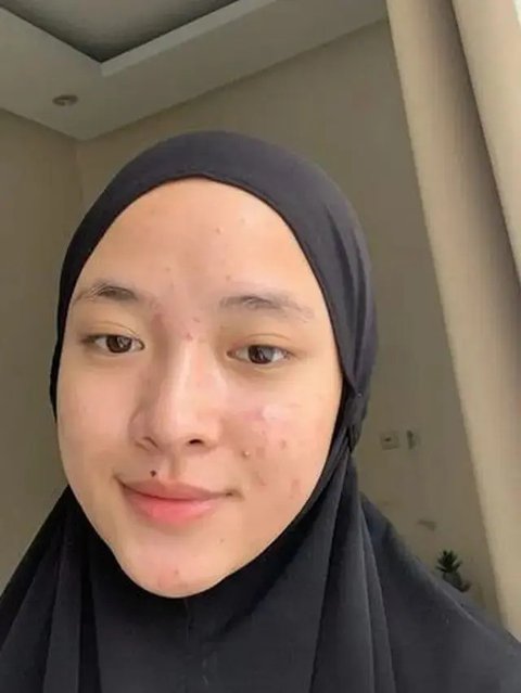 Potret Nissa Sabyan Percaya Diri Tampilkan Wajah Berjerawat Tanpa Makeup, Bikin Pangling