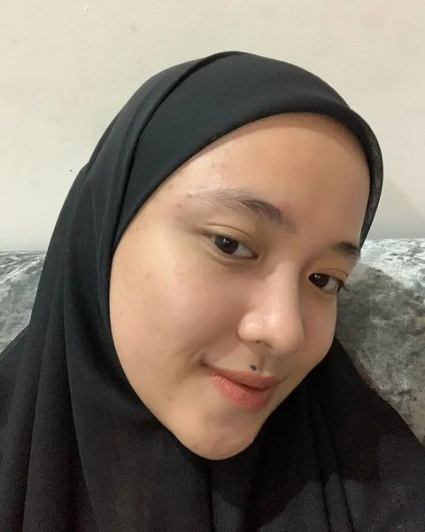 Potret Nissa Sabyan Percaya Diri Tampilkan Wajah Berjerawat Tanpa Makeup, Bikin Pangling