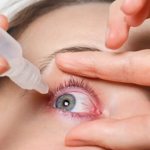 Perlu Waspada! Softlens Tidak Sesuai Bisa Sebabkan Mata Iritasi, ini 7 Tanda-Tandanya