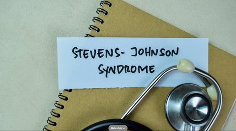 Steven Johnson Syndrome: Panduan untuk Pasien dan Keluarga dalam Proses Diagnosa