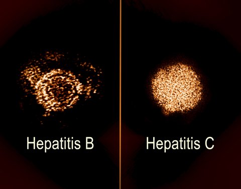 Waspadai Hepatitis: Fakta, Mitos, dan Tips Pencegahannya