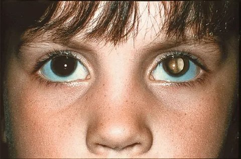 Gejala Retinoblastoma pada Anak yang Perlu Diwaspadai