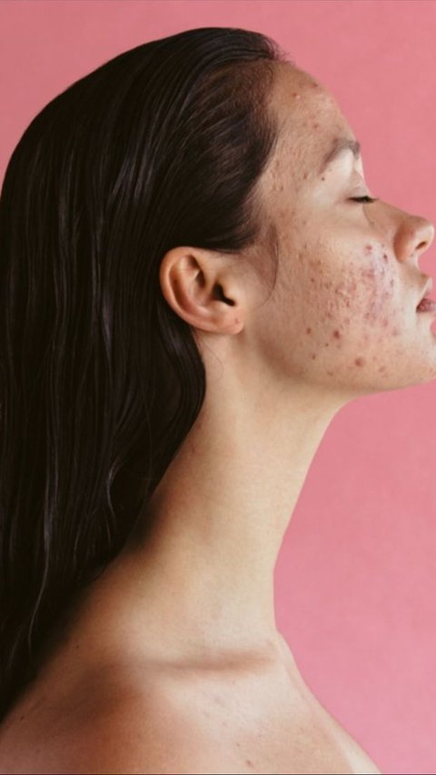 <b>Pilih Skincare yang Tepat untuk Kulit Acne Prone</b>