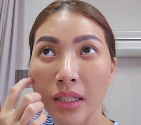 Kondisi Terbaru Sarwendah Usai Jalani Operasi dengan Hidung Diperban, Sakit Apa?