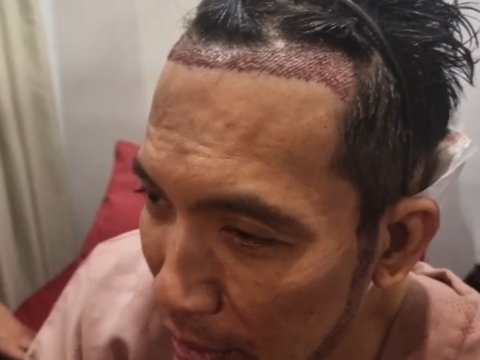 Bikin Pangling! 10 Potret Terbaru Desta Jalani Transplantasi Rambut di Klinik Tompi, Bakal Tampil Brewokan