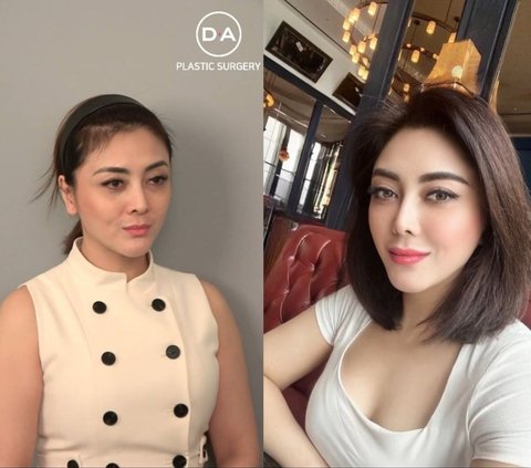 10 Artists Before VS After Plastic Surgery in 2024, Mahalini Raharja & Rizky Febian Instead Get Mocked