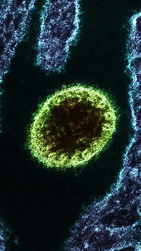 Gejala Virus Nipah yang Perlu Diwaspadai, Begini Cara Mencegahnya