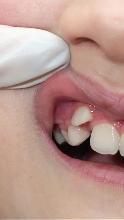 Dampak Buruk Gigi Gingsul yang Perlu Diwaspadai, Tak Selalu Menarik