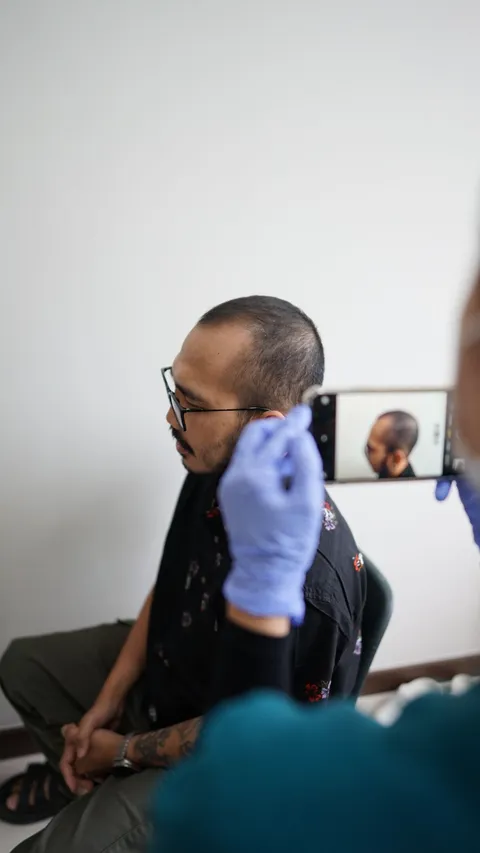 Mengenal Teknik DHI, Mengatasi Kebotakan dengan Tanam Rambut dengan Cara Modern