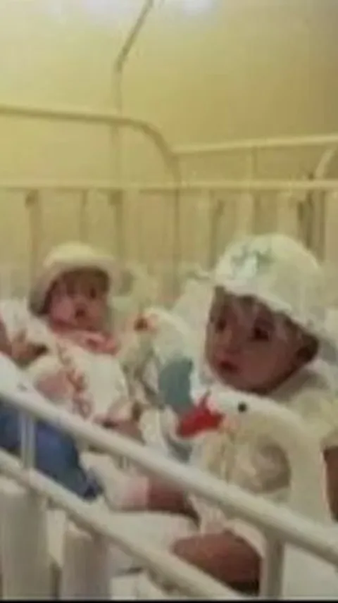 Bayi Kembar Siam Pertama Indonesia, Kini Nasibnya Cemerlang Sukses Jadi Dokter Dulu Ditolong Sosok ‘Malaikat tak Bersayap