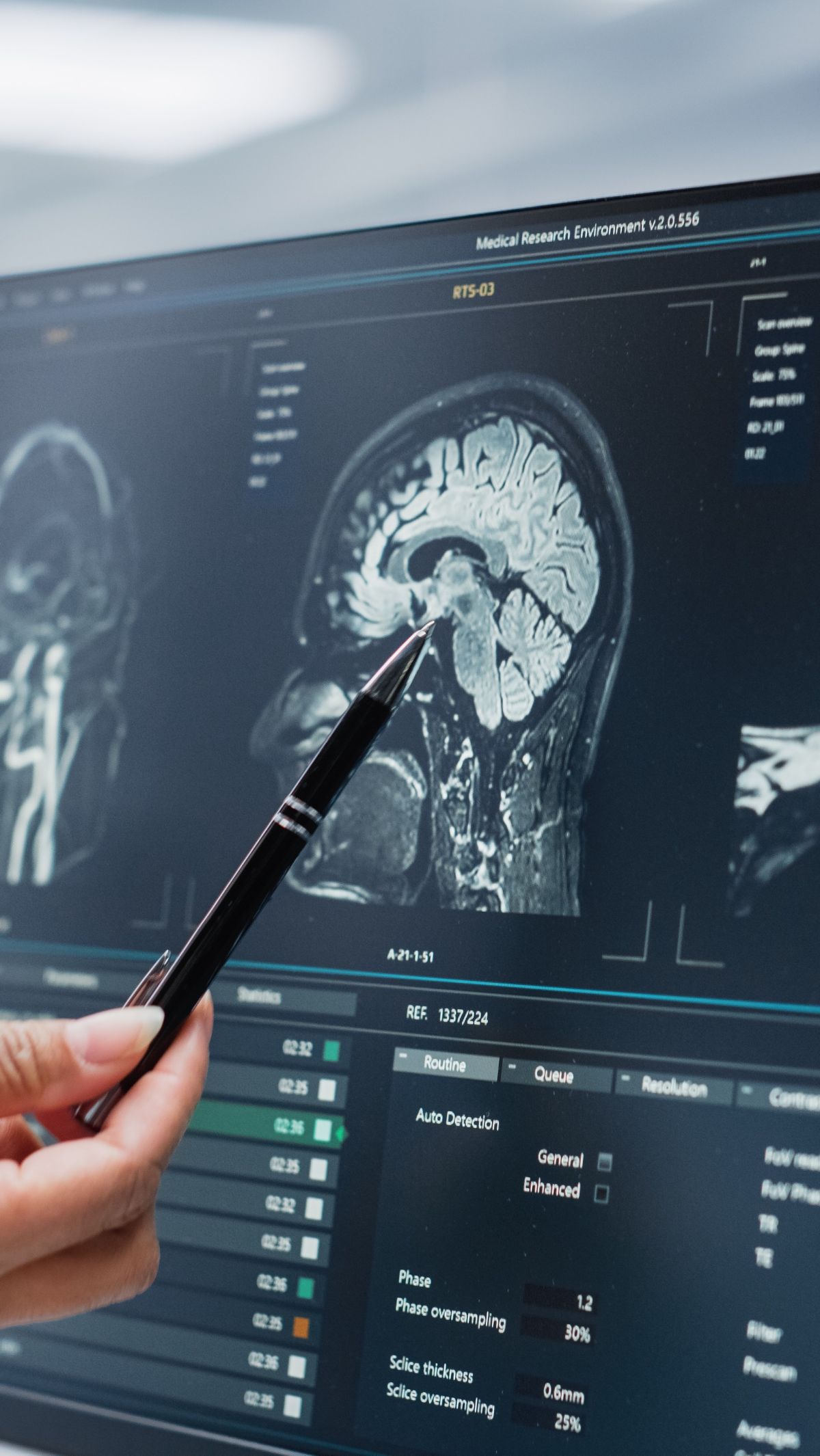 CT Scan Penggila Kopi dan Bergadang Bikin Takut Warganet, Usia 30 Pendarahan Otak
