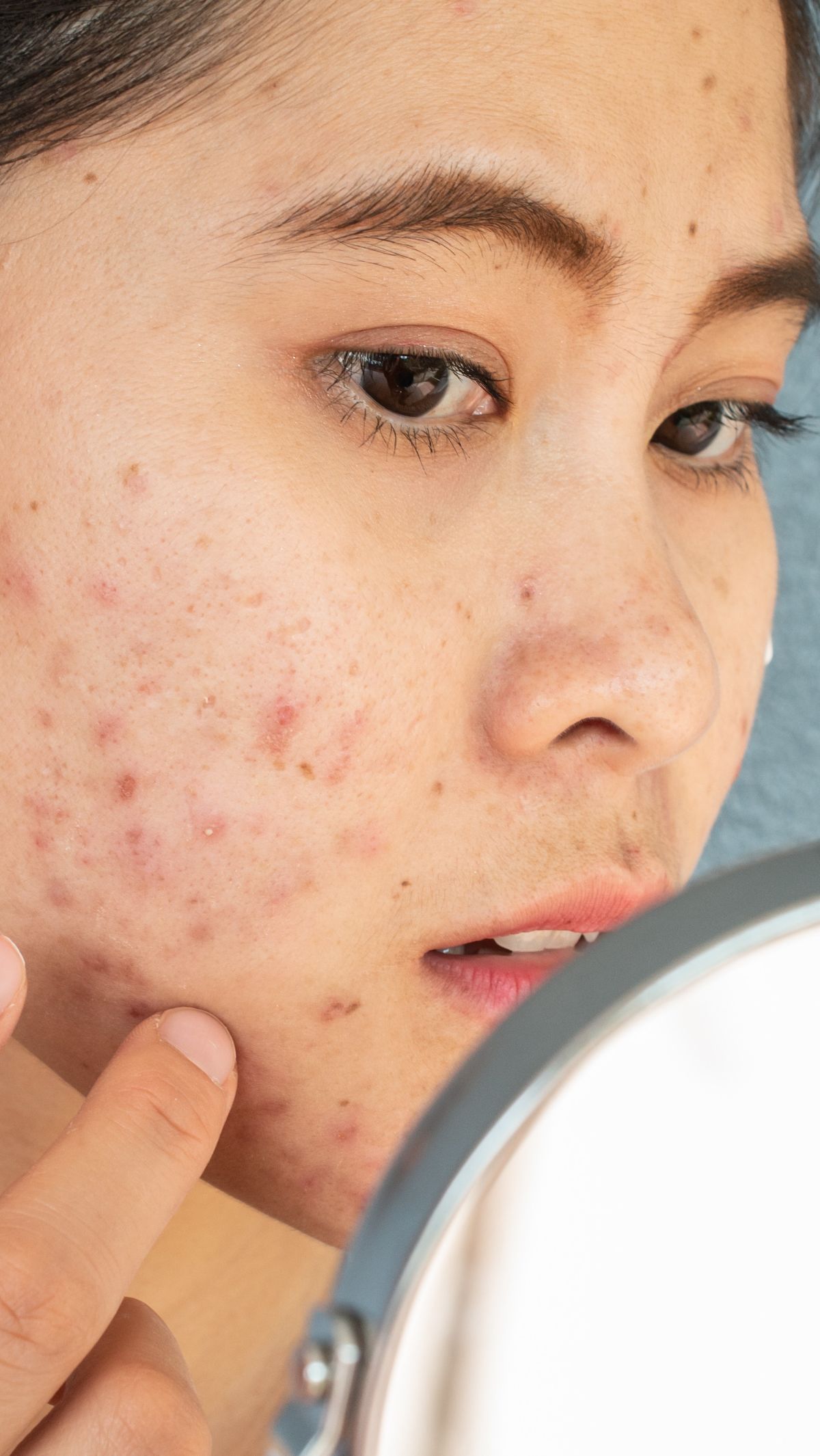 Kulit Bopeng Tak Mempan Hanya Pakai Skincare Biasa,  Dokter Beri Penjelasan