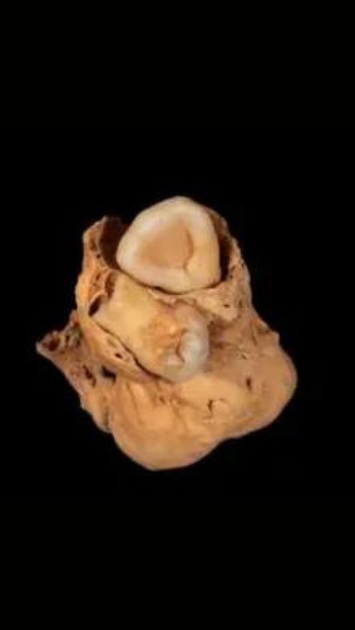 Arkeolog Temukan Kerangka Wanita Mesir Kuno Penderita Tumor Langka Bawa Jimat Penyembuh<br>
