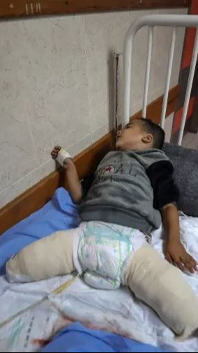 Kisah Pilu Bocah Tiga Tahun di Gaza, Bom Israel Renggut Semua Keluarganya dan Kini Harus Hidup Tanpa Kaki