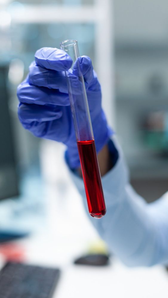 What Causes Blood Clots 9 Common Reasons And How To Prevent It