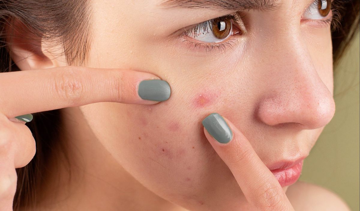 Alasan Kulit Berjerawat Setelah Facial