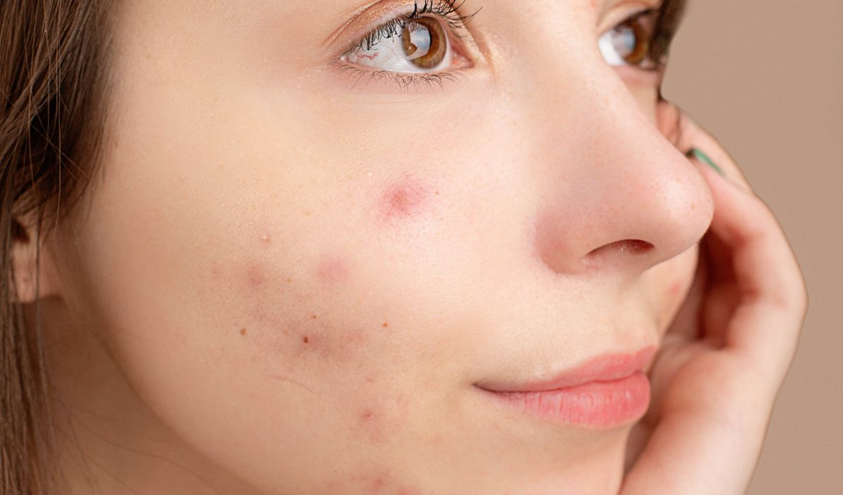 Cara Mengatasi Jerawat Pasca Facial