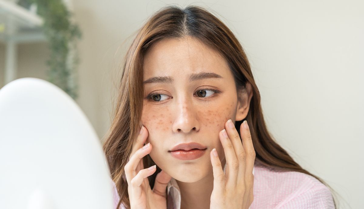 2. Melasma