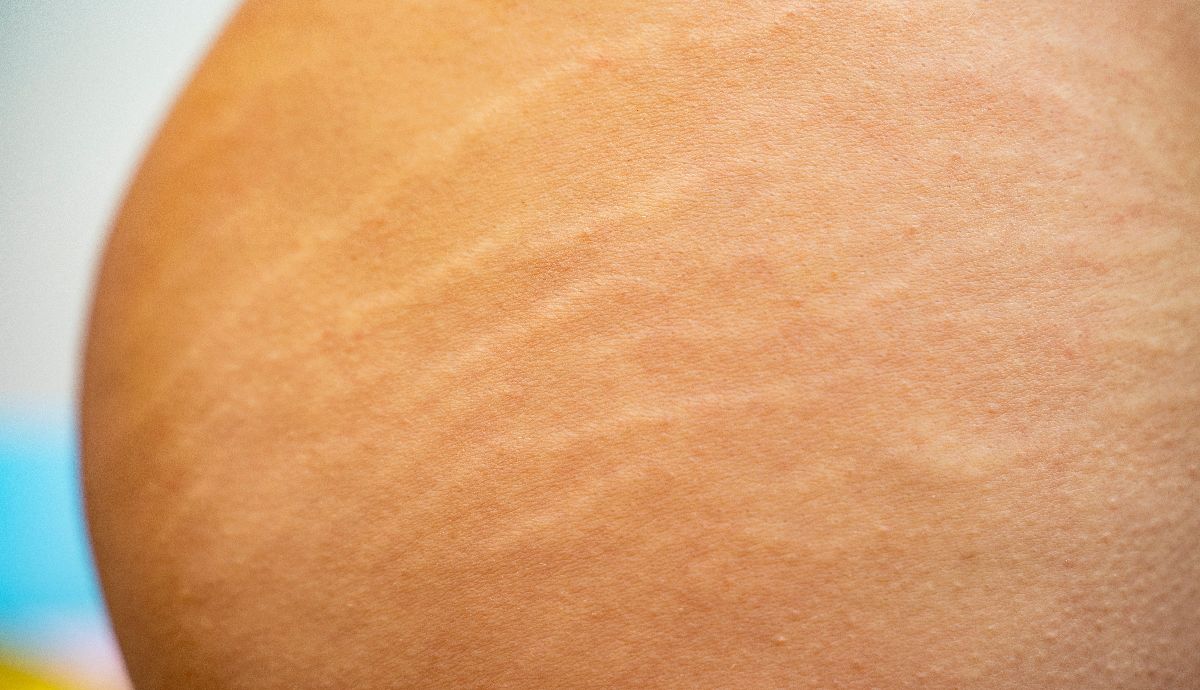 3. Stretchmarks