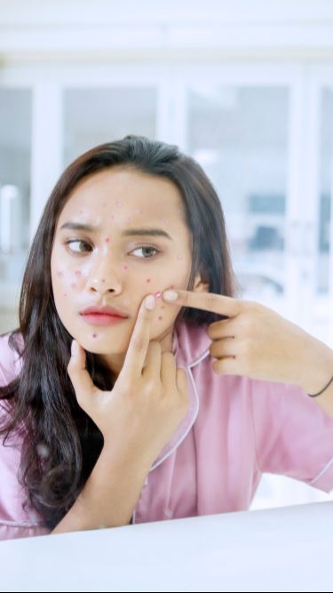 Menilik Akar Permasalahan Jerawat Hormonal, Begini Cara Mengatasinya