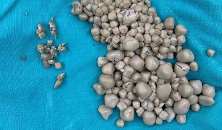 Sebagian besar batu bentuknya mirip dengan bakpao mini,