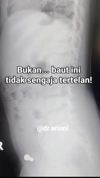 Ngilu, Dokter Anak Bagikan Pengalamannya Tangani Bocah 4 Tahun Menelan Baut