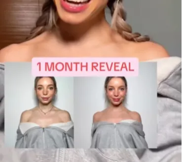 Woman Get 'Barbie Botox' to Make Her Neck Longer Like Doll