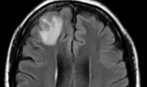 The patient, a 64-year-old Australian woman, had memory problems. She also experienced depression for several months before being hospitalized.
